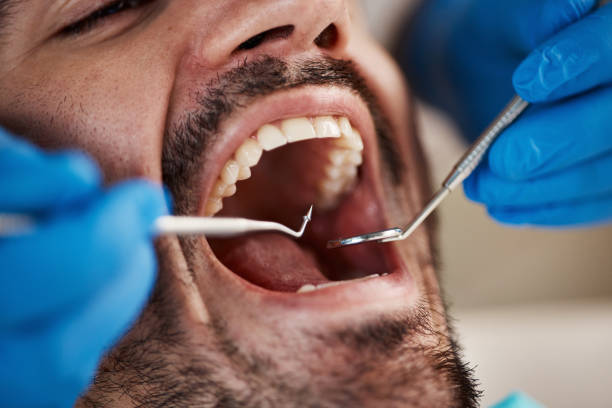 Dental Bonding in Stanwood, WA
